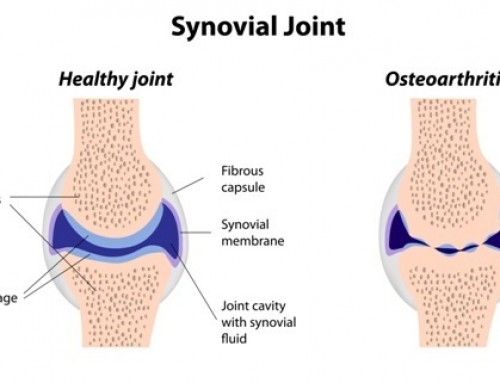 Evidence for physiotherapy management of osteoarthritic knees.